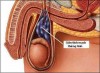 Phẫu thuật điều trị giãn tĩnh mạch tinh: những điều cần biết