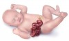 Khe hở thành bụng gastroschisis