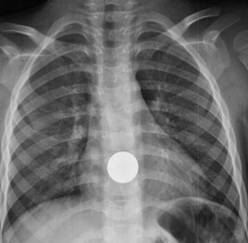 Dị vật đường tiêu hóa và đường hô hấp